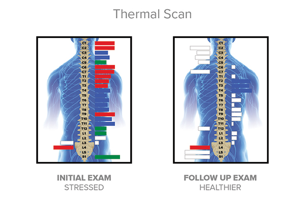 Chiropractic Edina MN Thermal Scan