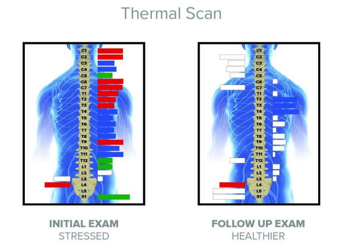 Chiropractic Edina MN Thermal Scan